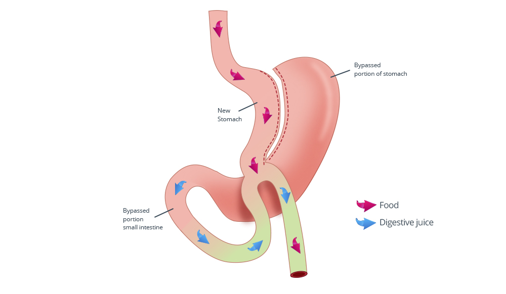 Mini Gastric By-Pass Kesler Clinic